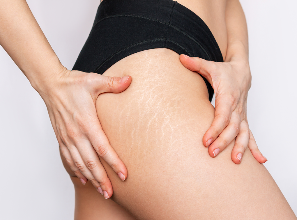 Reconstruction aréoles et cicatrices